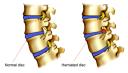 Herniated Disc Treatment logo