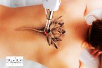 Premium Tattoo Removal image 2