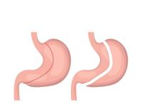 gastric sleeve surgeon image 1