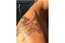 Renude Laser Tattoo Removal image 5