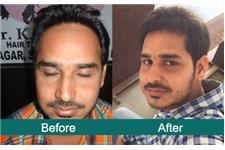 Satyam Hair Transplant Australia image 1