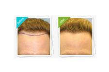 MediHair Hair Transplant Melbourne image 4