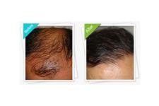 MediHair Hair Transplant Melbourne image 5