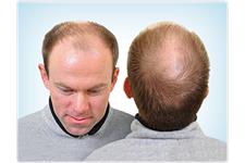 PRP Hair Regrowth image 2