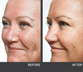 Dermal Fillers & Wrinkle Relaxers Port Hedland image 2