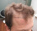 Hair Transplant - Australasian Hair Transplant Institute image 5