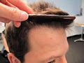 Hair Transplant - Australasian Hair Transplant Institute image 6