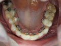 Invisible Lingual Braces logo