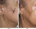 Dermal Fillers Adelaide - Skin Deep Sema4 image 2