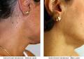 Dermal Fillers Adelaide - Skin Deep Sema4 image 5