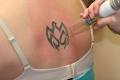 Tattoo Removal Sydney image 2