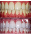 Mobile Teeth Whitening Gold Coast Snow White image 2