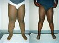 Newcastle Lymphoedema Clinic image 6